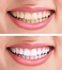 Laser Whitening Toothpaste - Triple Strength 6 of 50ml